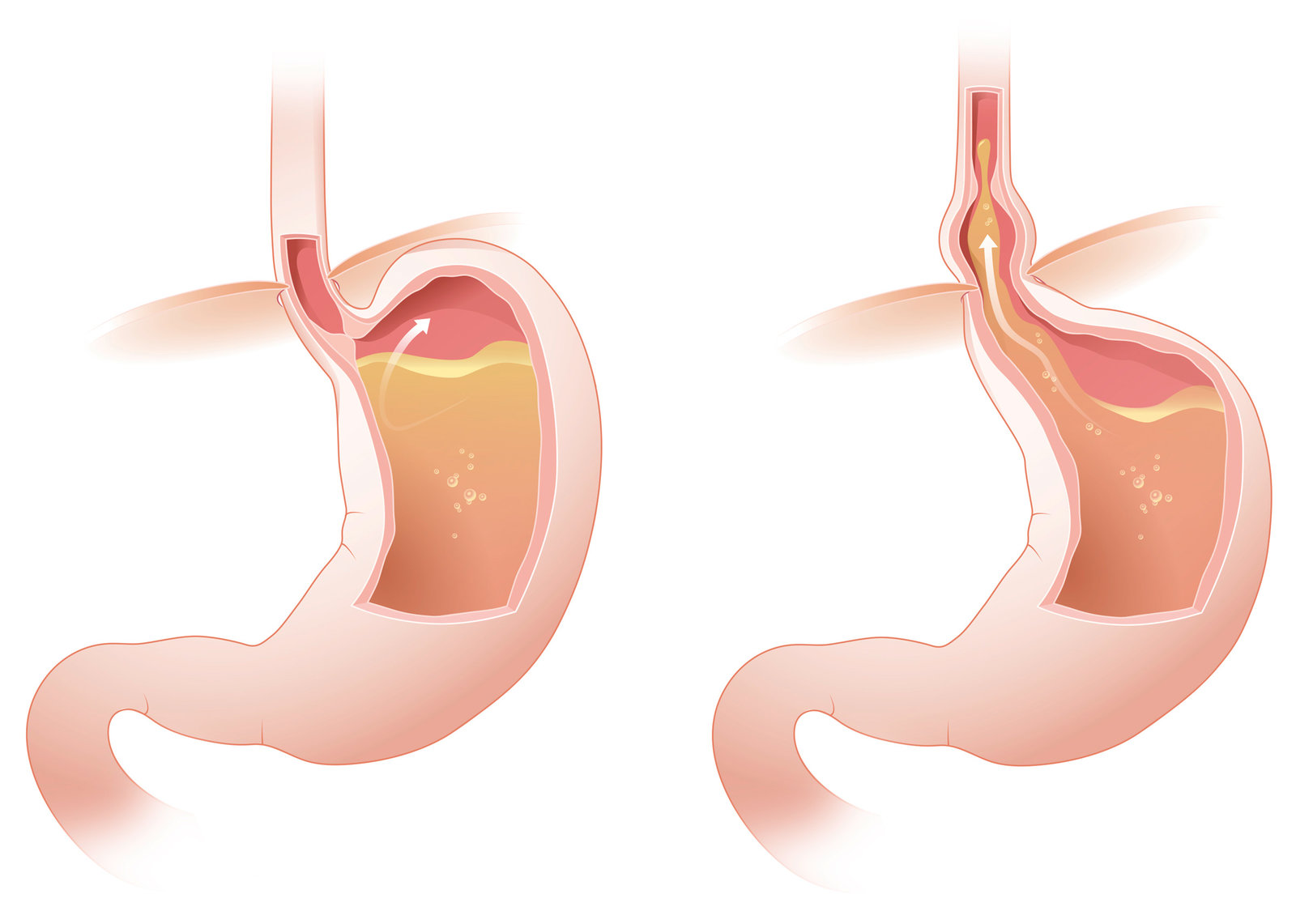 oculus-illustration-magen-funktion_reflux
