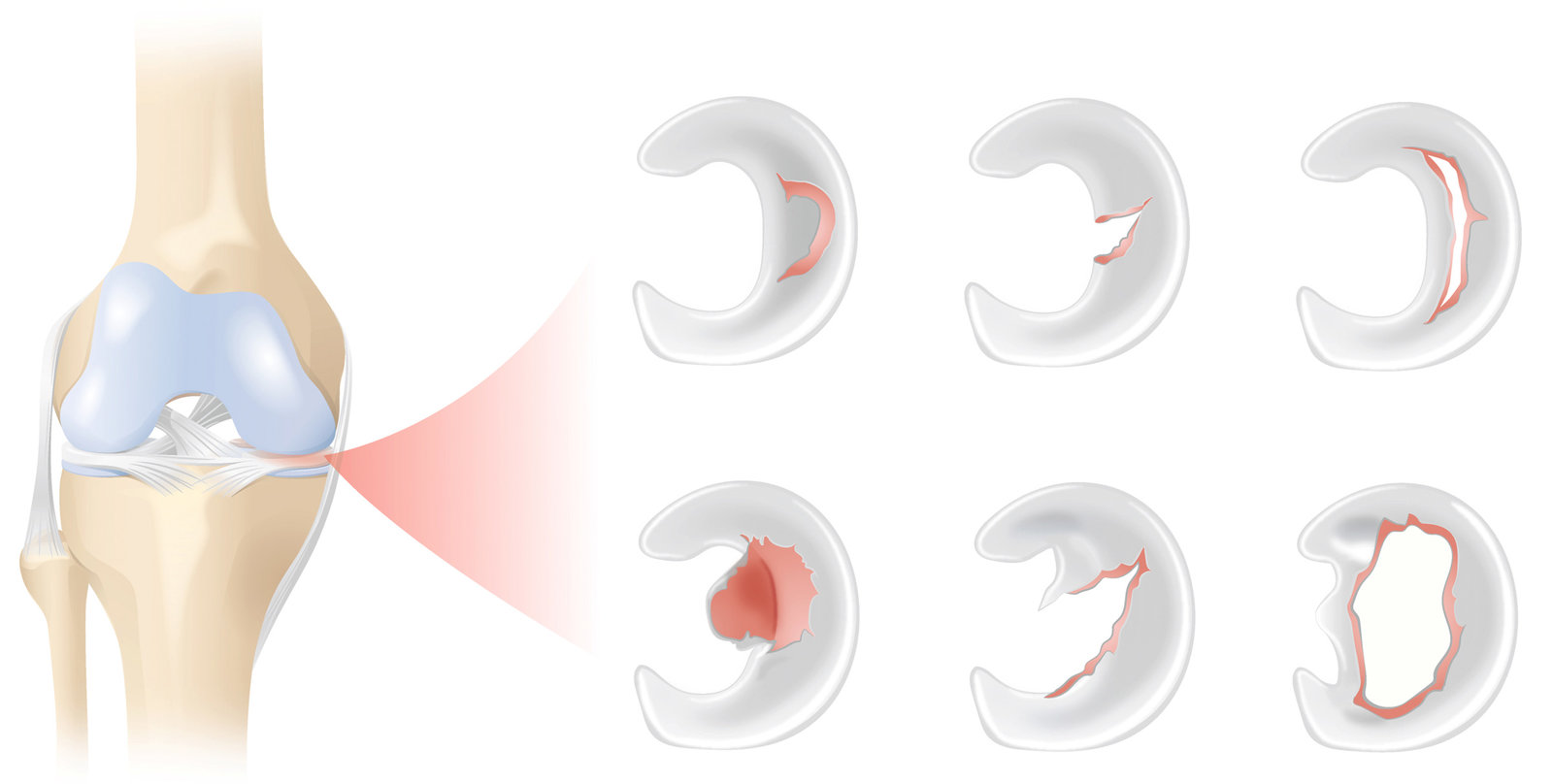 oculus-illustration-medizin-gelenkchirurgie-meniskus