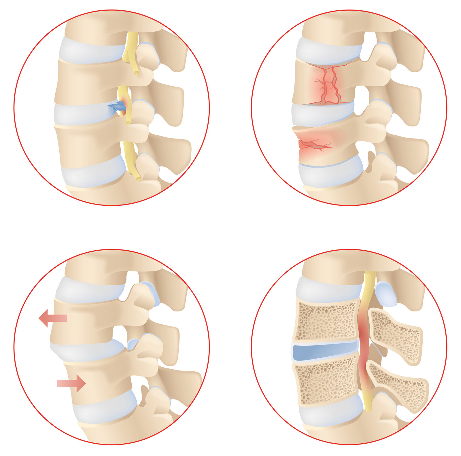oculus-illustration-medizin-gelenkchirurgie-wirbelsaeule-beschaedigungen