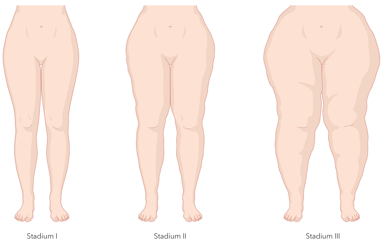 oculus-illustration-medizin-lymphchirurgie-lipoedem-stadien