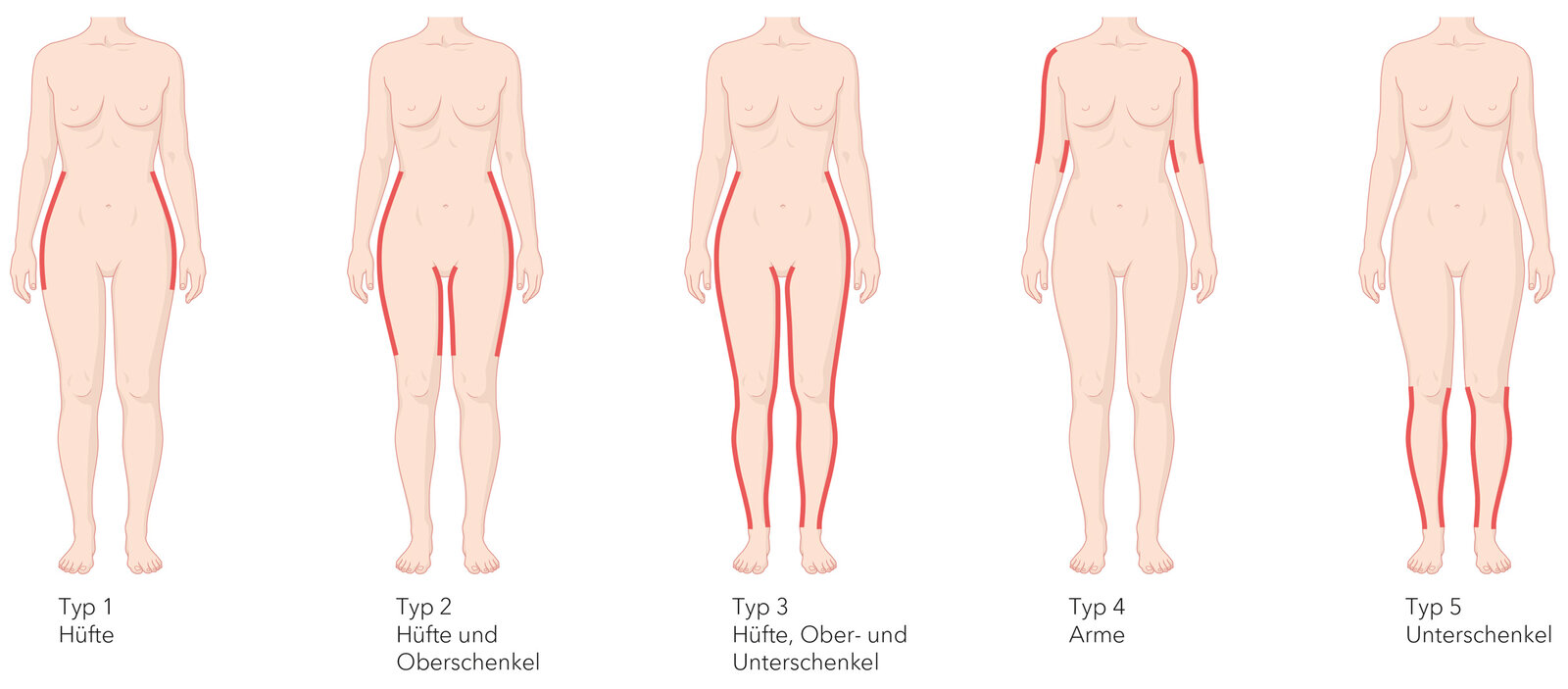 oculus-illustration-medizin-lymphchirurgie-lipoedem-typen