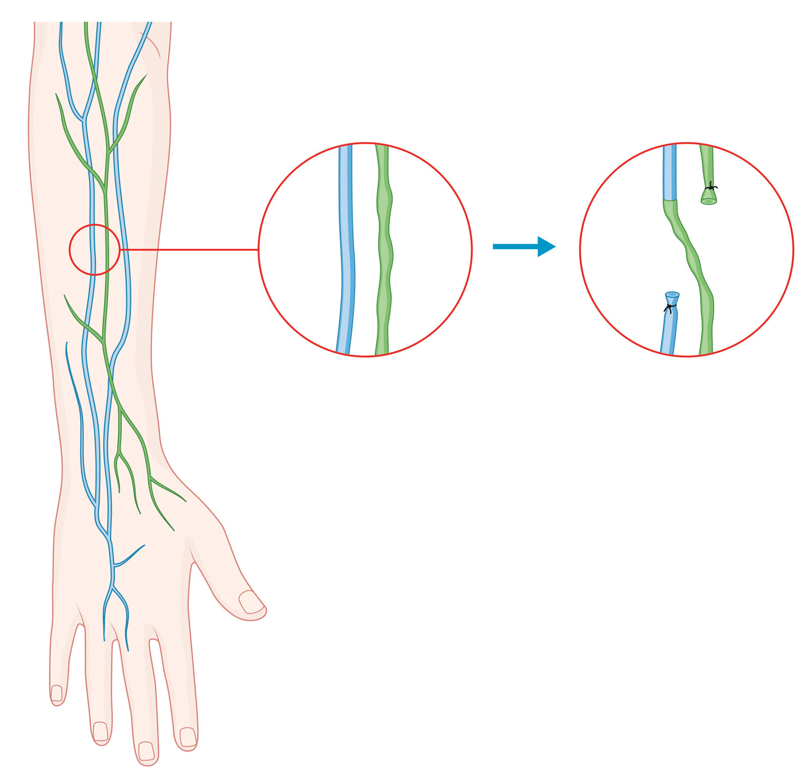 oculus-illustration-medizin-lymphchirurgie-lymphoedem-anastomose