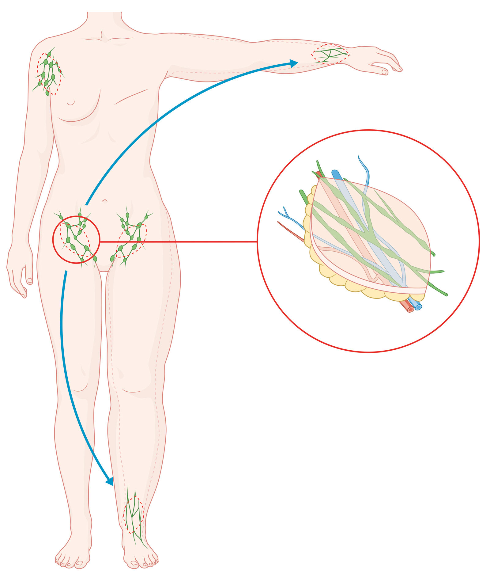 oculus-illustration-medizin-lymphchirurgie-lymphoedem-lymphgefaesstransfer