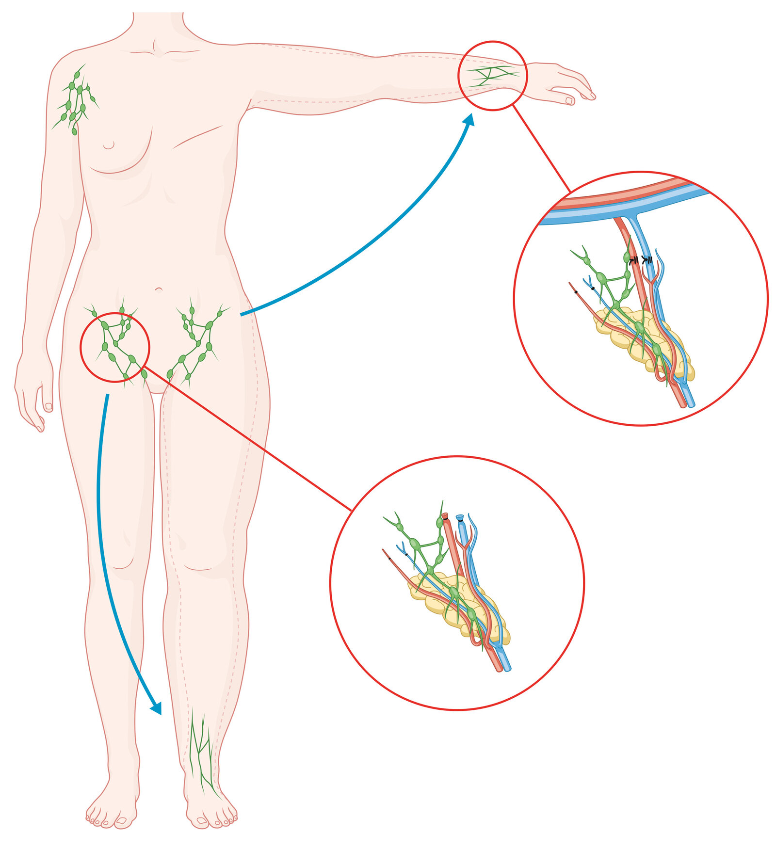 oculus-illustration-medizin-lymphchirurgie-lymphoedem-lymphknotentransfer