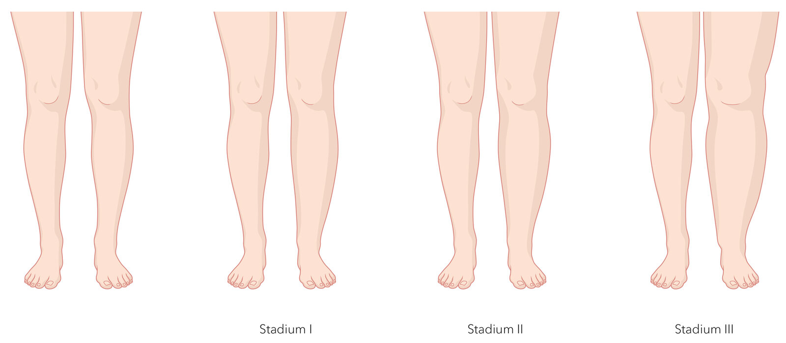 oculus-illustration-medizin-lymphchirurgie-lymphoedem-stadien