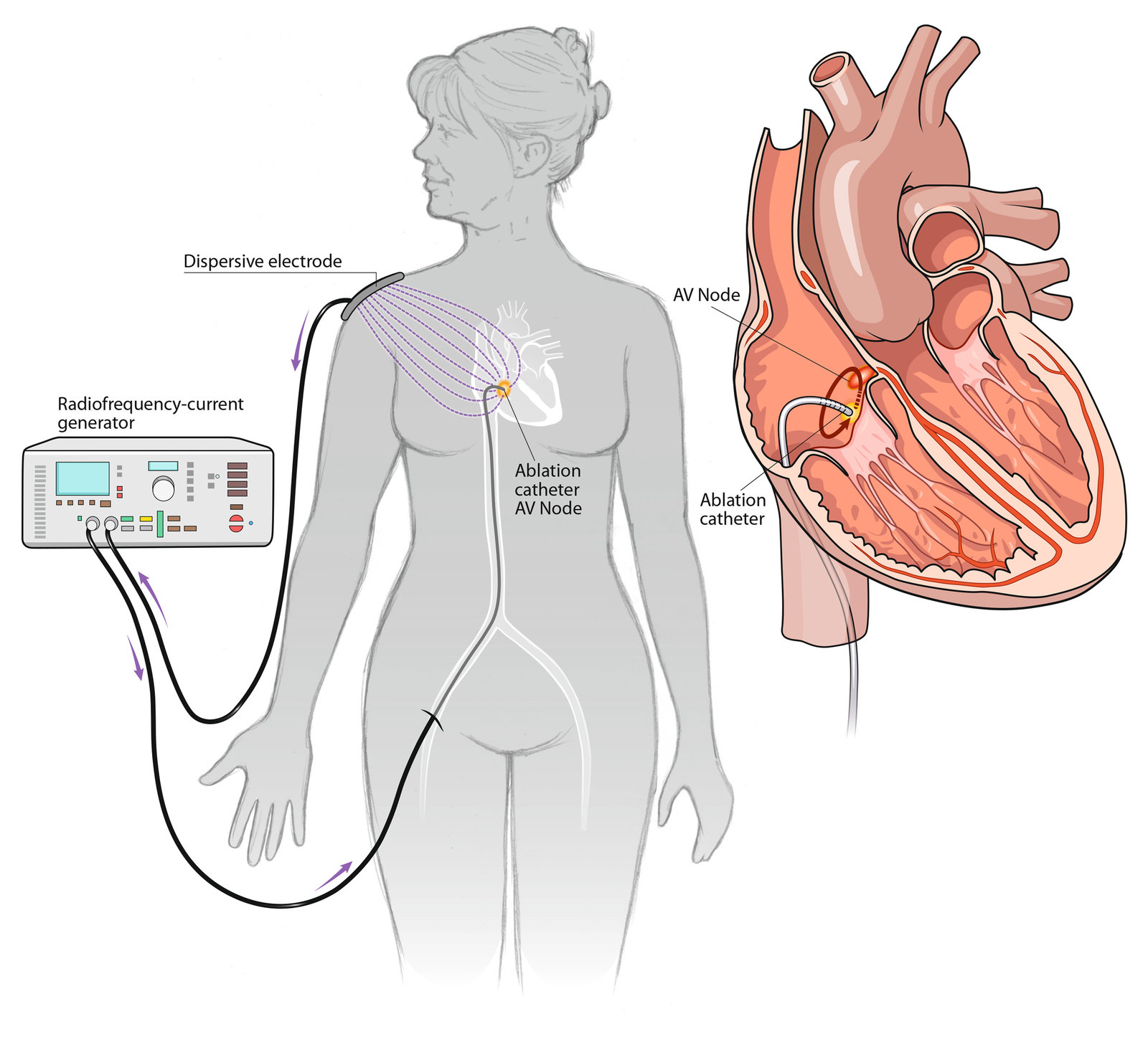 oculus-illustration-patientenbroschuere-herz-ep-study