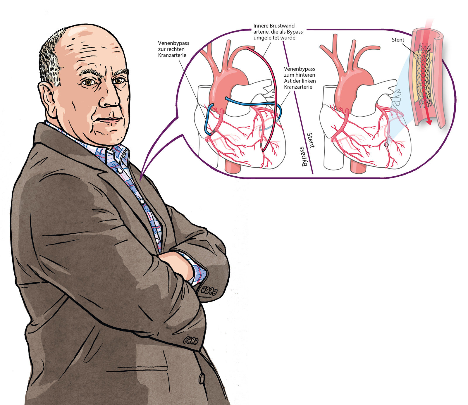 oculus-illustration-patientenkarte-bypass-stent