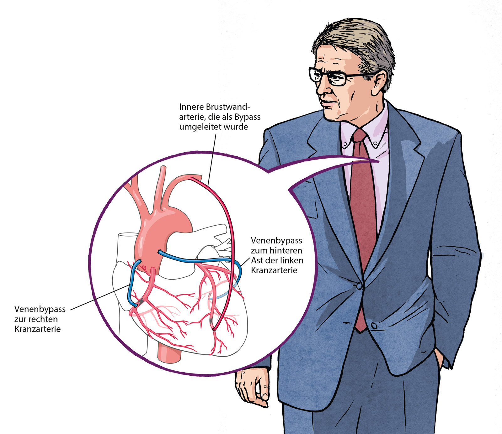 oculus-illustration-patientenkarte-bypass