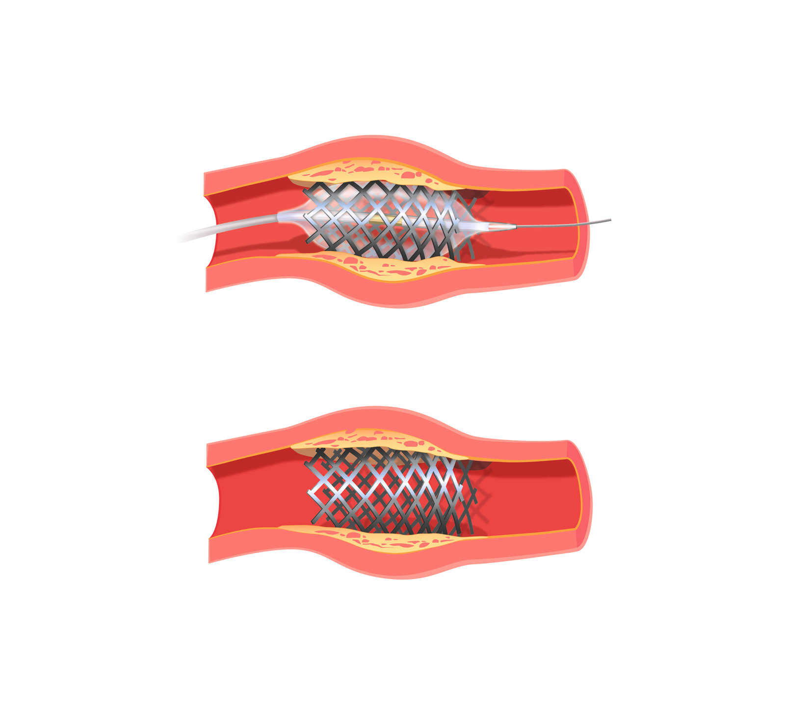 oculus-illustration-spital-herz-kardiologie-stent