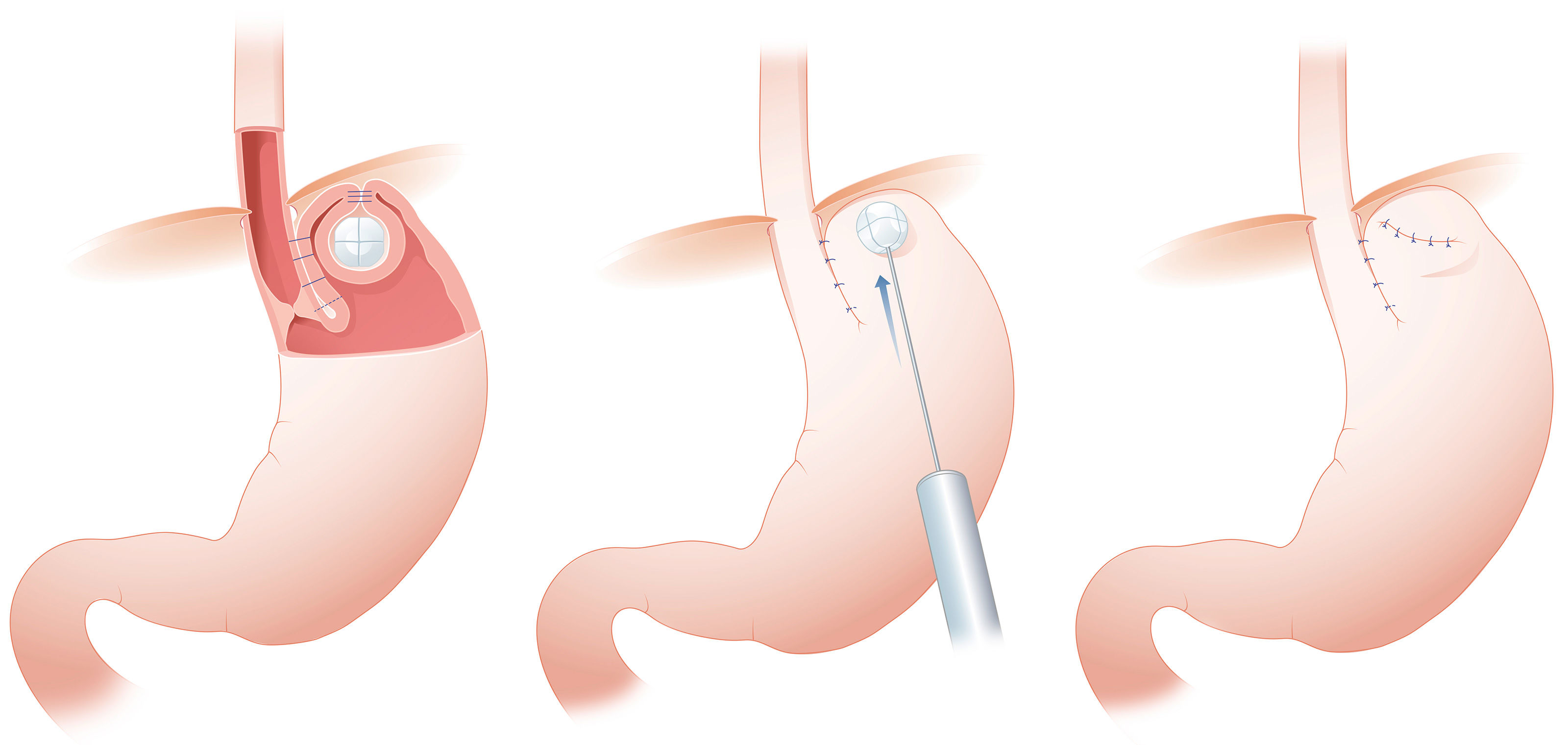oculus-illustration-magen-implantat-operation