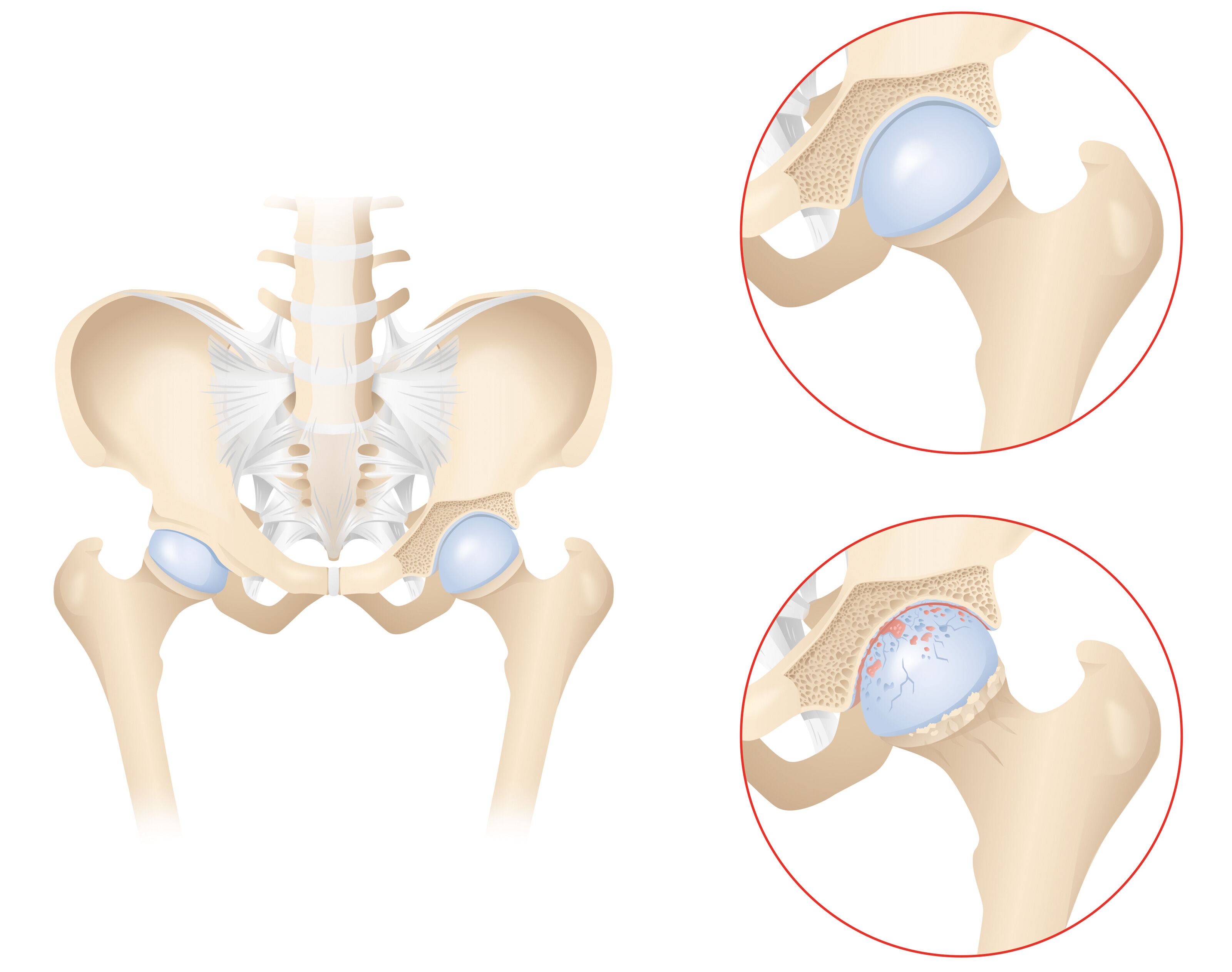 oculus-illustration-medizin-gelenkchirurgie-huefte-arthrose