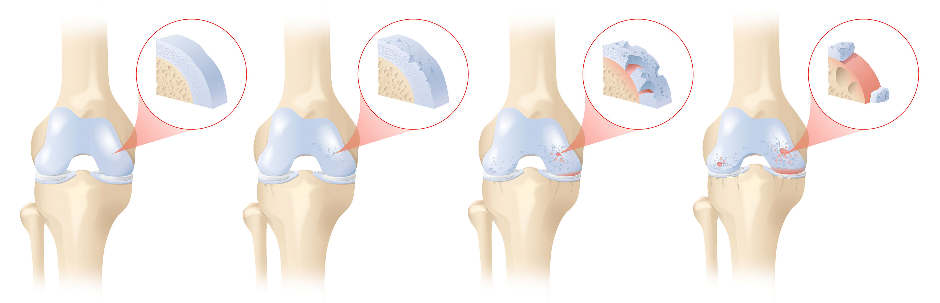 oculus-illustration-medizin-gelenkchirurgie-knie-arthrose