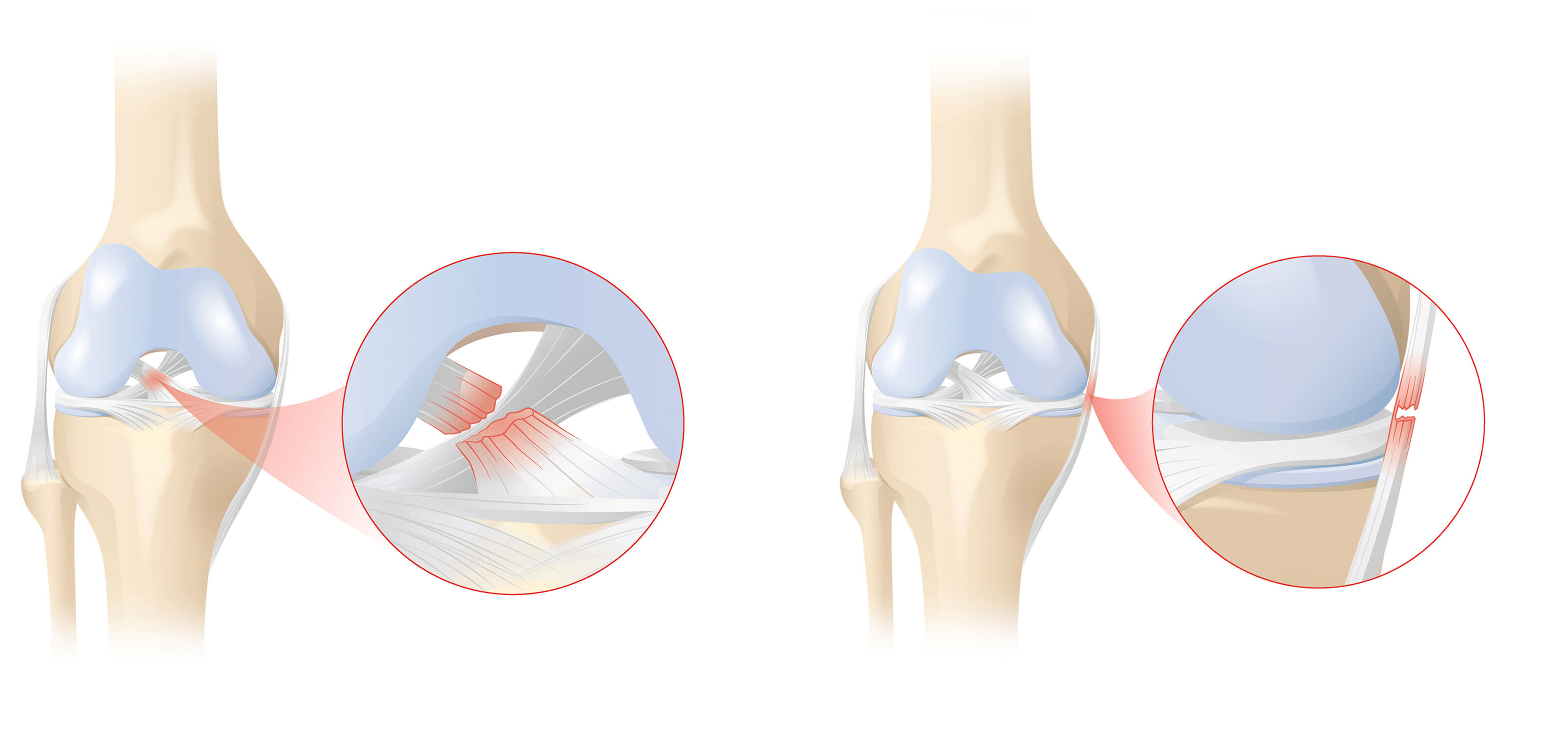 oculus-illustration-medizin-gelenkchirurgie-kreuzband