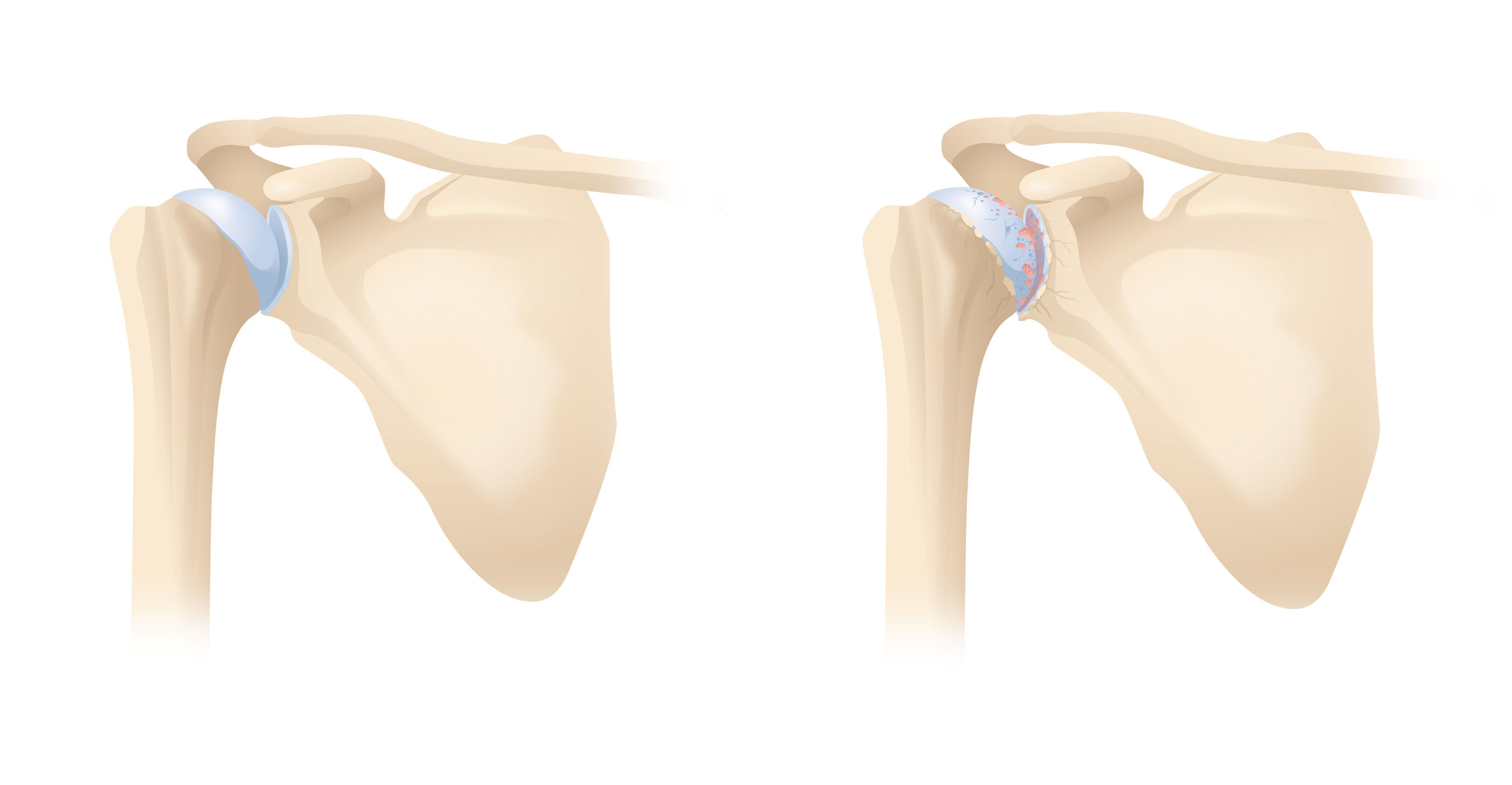 oculus-illustration-medizin-gelenkchirurgie-schulter-arthrose