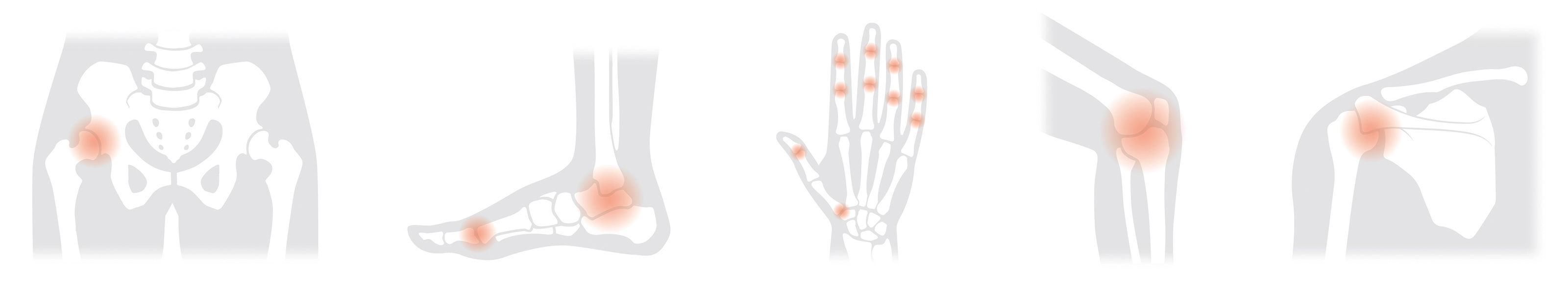 oculus-illustration-medizin-koerperteile_arthrose