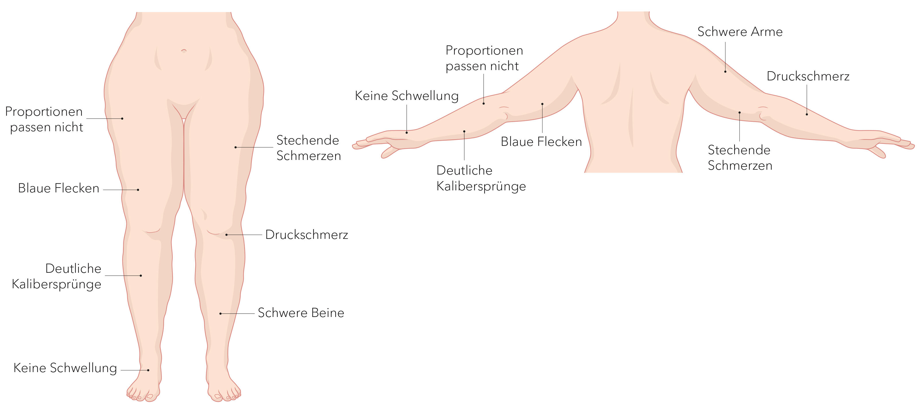 oculus-illustration-medizin-lymphchirurgie-lipoedem-symptome