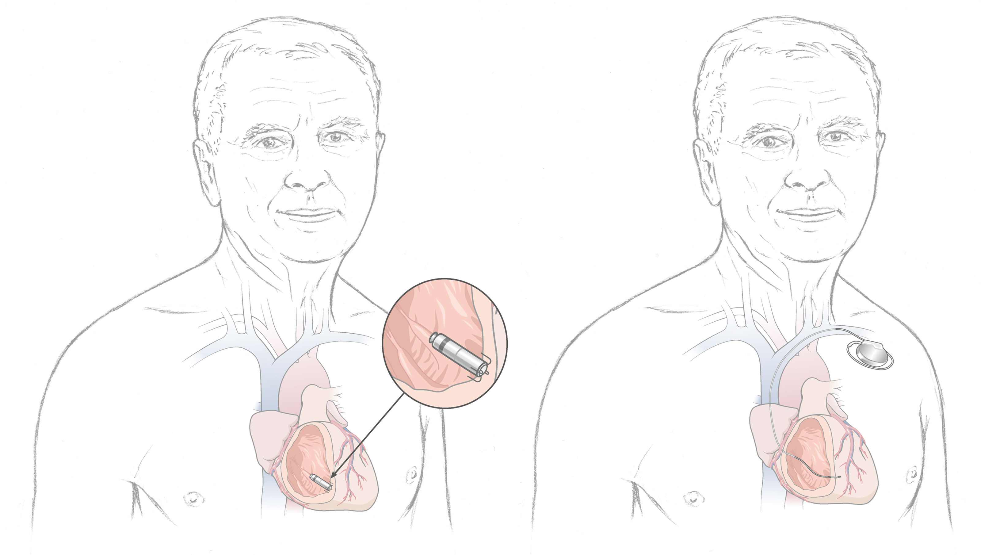 oculus-illustration-spital-herz-kardiologie-kardiokapsel