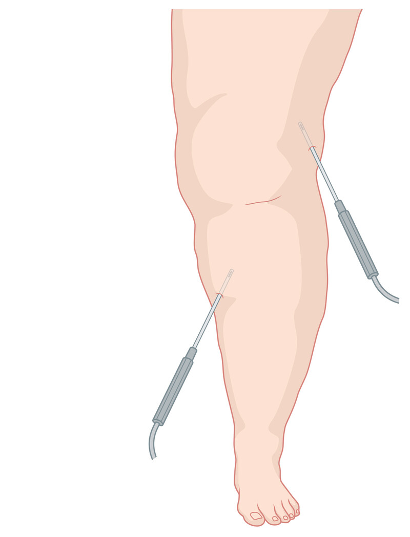 oculus-illustration-medizin-lymphchirurgie-lipoedem-fettabsaugung